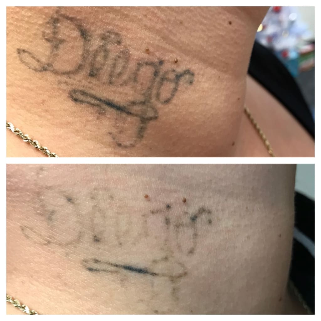 Laser Tattoo Removal