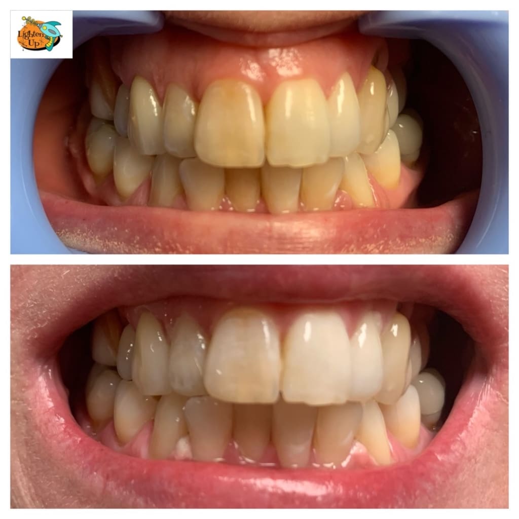 In Office Teeth Whitening