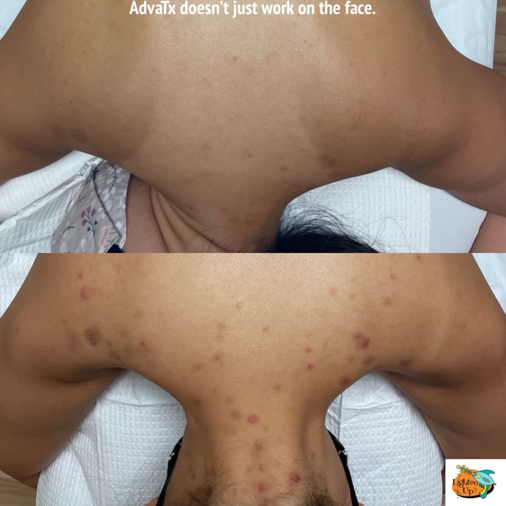 AdvaBright treatment