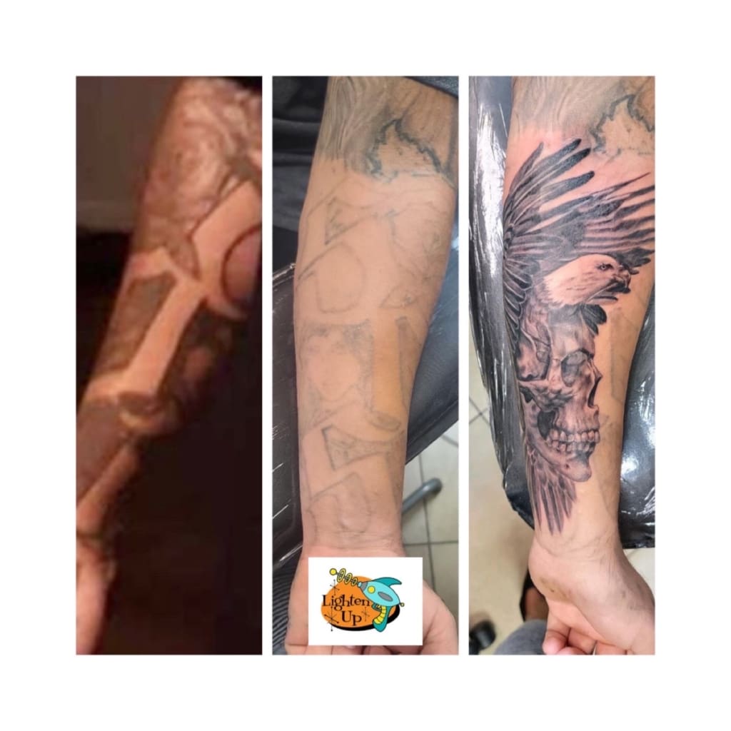Laser Tattoo Removal Phoenix